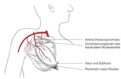 pectoralis major lappen|Gestielte und freie Lappen zur Rekonstruktion des Kopf